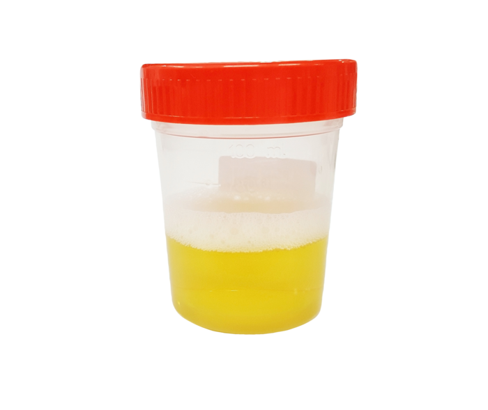 Urinbecher mit gelblicher Flüssigkeit. Auf der Oberfläche eine Schicht mit Luftblasen.