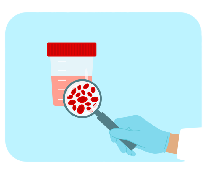 Schematische Darstellung eines Urinbechers mit rötlicher Flüssigkeit. Davor eine Hand in blauem Einweghandschuh, die eine Lupe hält. Unter dem Lupenglas schematische Darstellung von roten Blutzellen.