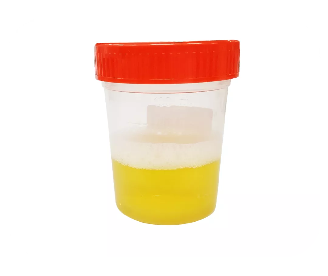 Urinbecher mit gelblicher Flüssigkeit. Auf der Oberfläche eine Schicht mit Luftblasen.