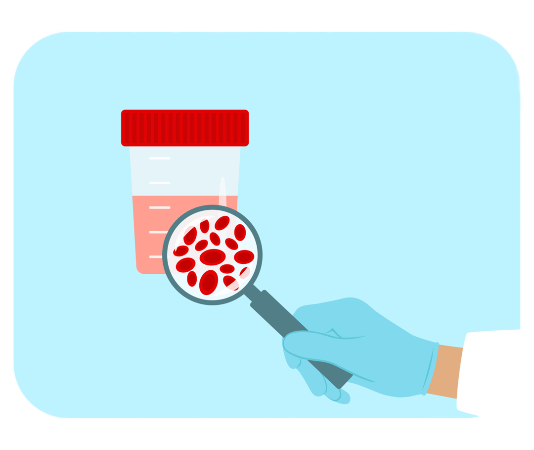 Schematische Darstellung eines Urinbechers mit rötlicher Flüssigkeit. Davor eine Hand in blauem Einweghandschuh, die eine Lupe hält. Unter dem Lupenglas schematische Darstellung von roten Blutzellen.