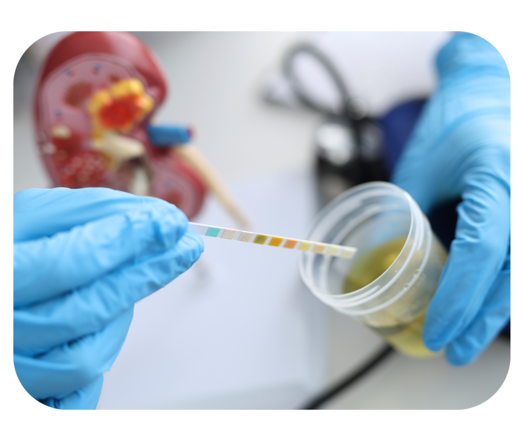 Behandlung der IgA-Nephropathie: regelmäßige Kontrolluntersuchungen  Eine Person mit Handschuhen taucht einen Teststreifen in einen Behälter mit gelblicher Flüssigkeit.