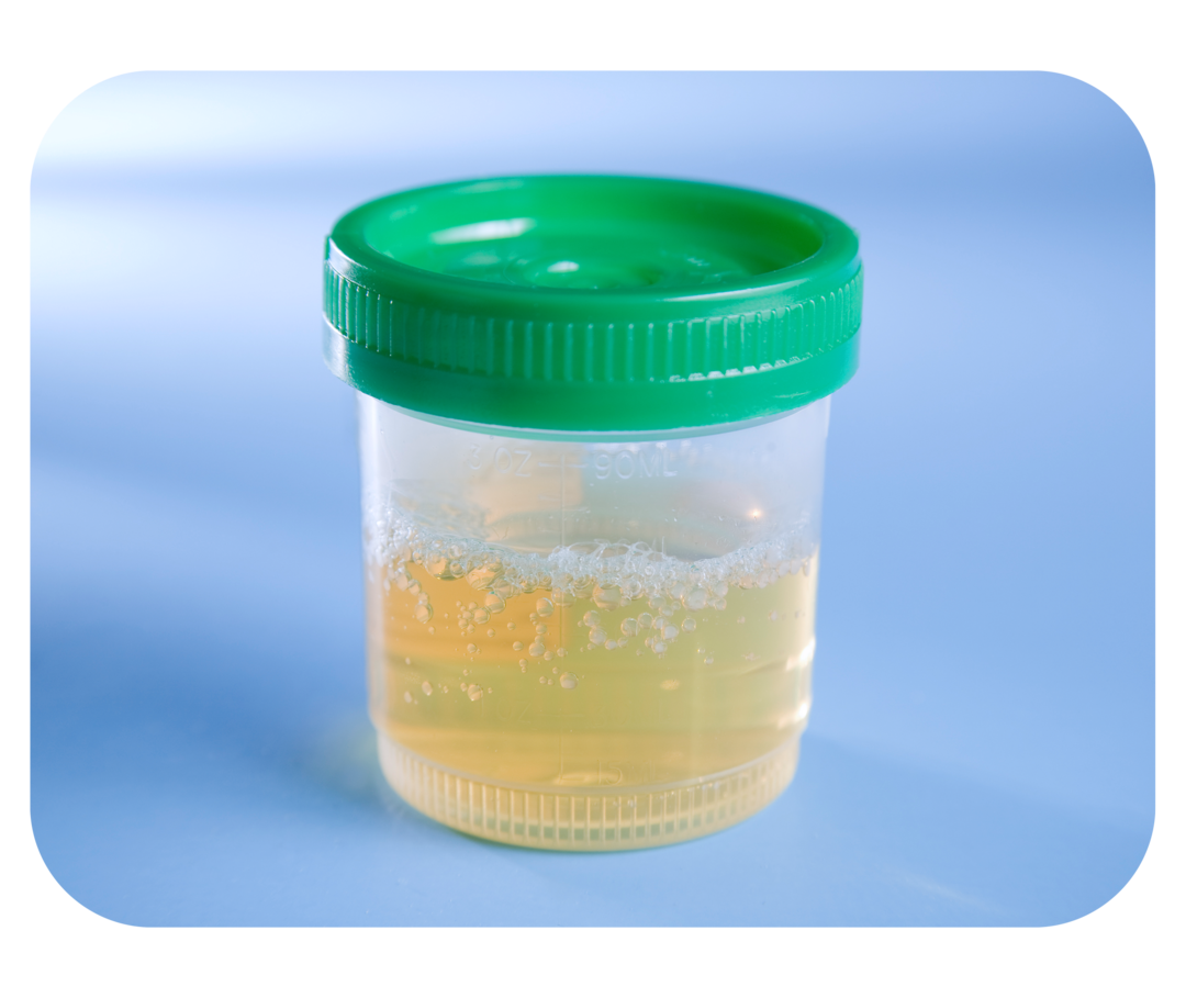 Becher mit einer schäumenden gelblichen Flüssigkeit. 