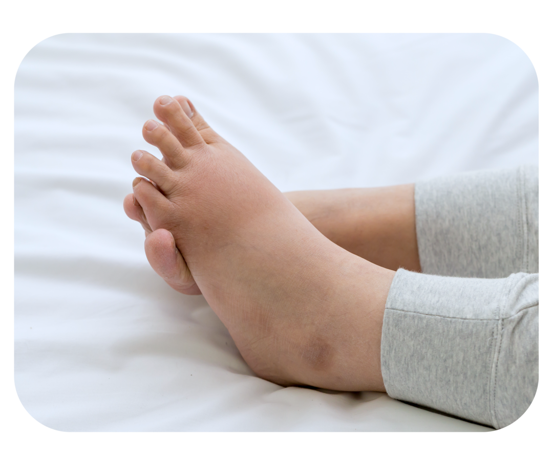 Füße mit Schwellungen an Knöcheln und Fußrücken. 