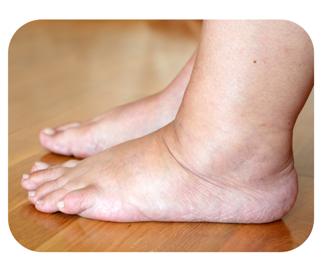 Geschwollene Füße und Knöchel.